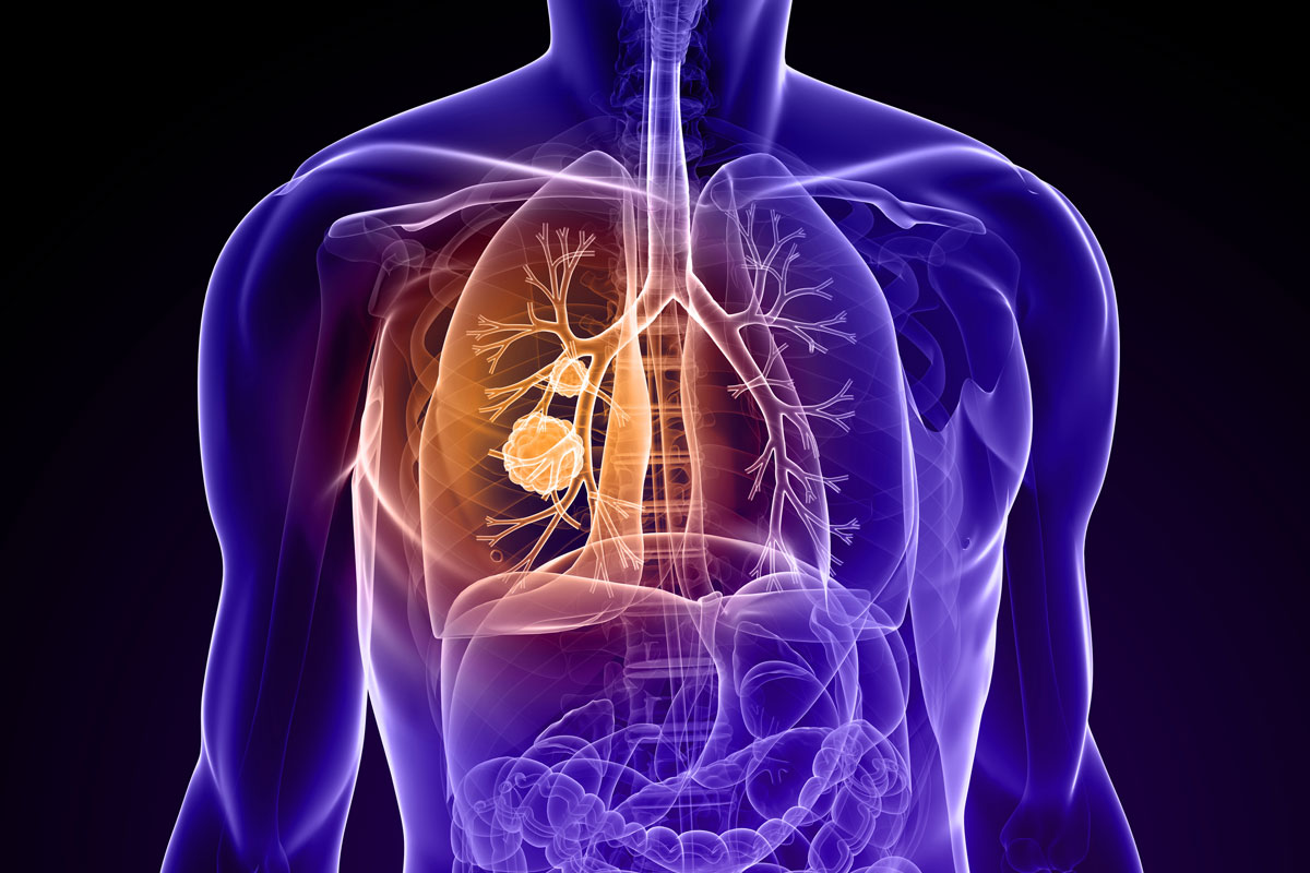 Porter Regional Hospital Changing Paradigms in Screening and Treatment of Lung Cancer